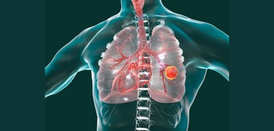 克服標靶藥副作用挑戰，平衡肺癌治療與生活品質。（來源：123rf）