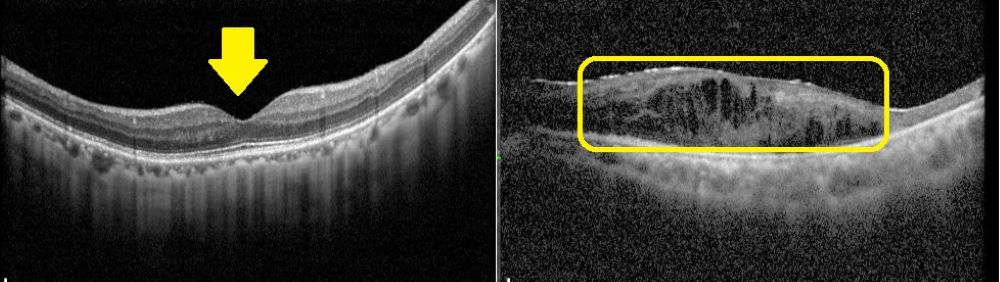 《圖說》賴旗俊指出正常黃斑部的結構層次分明，中央呈現凹陷（圖左箭頭處），而黃斑部病變會因水腫造成結構模糊、隆起（圖右框線處）。〈土城醫院提供〉